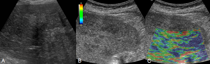 Figure 4: Ultrasonographic findings of a patient with chronic hepatitis B, and (A) displays rough hepatic parenchymal echoes, an irregular hepatic surface, and numerous regenerating nodules. A subcostal scan shows enlargement of the left lobe with a blunting edge (B). Elastography indicates variable stiffness in hepatic parenchyma (C).