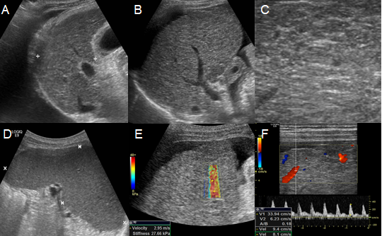 Figure 5: Ultrasound findings of patients with decompensated liver cirrhosis. An intercostal scan shows a moderate amount of right pleural effusion, (A) and displays atrophy of the right liver lobe (B). The hepatic parenchyma appears highly echogenic with numerous regenerative nodules, exhibiting diverse echoes ranging from low to high (C). A left intercostal scan shows splenomegaly more than 12 cm in length (D). Elastography demonstrates increased stiffness (E). Doppler flow of the portal vein is decreased to less than 15 cm/sec (F).