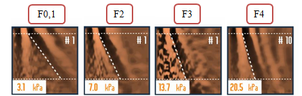 Figure 7: Liver stiffness measurement by transient elastography (FibroScan®), showcasing stages of liver fibrosis (METAVIR classification ranging from F0 to F4).