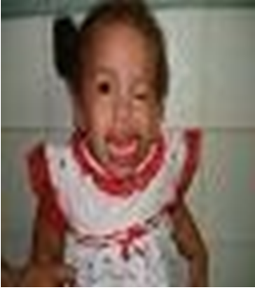 Figure 1: Microphthalmia, facial dysmorphia and lips deformity.