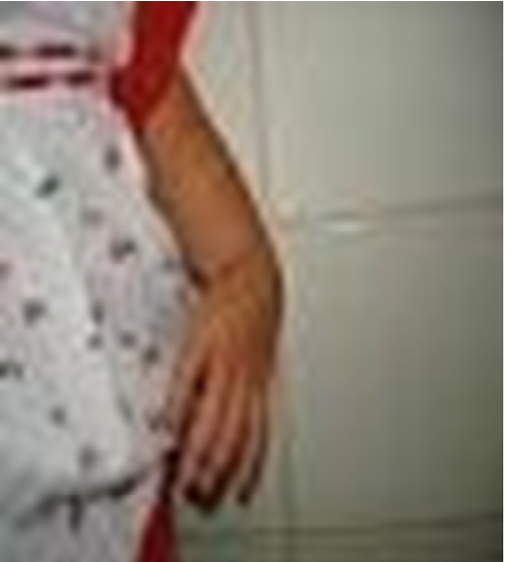 Figure 3: Absence of left radius and thumb.