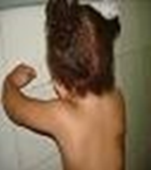 Figure 4: Lumbar and thoracic deformity.