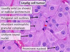 Figure 1: Leydig cell tumour delineating solid aggregates composed of polygonal cells incorporated with abundant, granular, eosinophilic cytoplasm and uniform nuclei with prominent nucleoli [5].