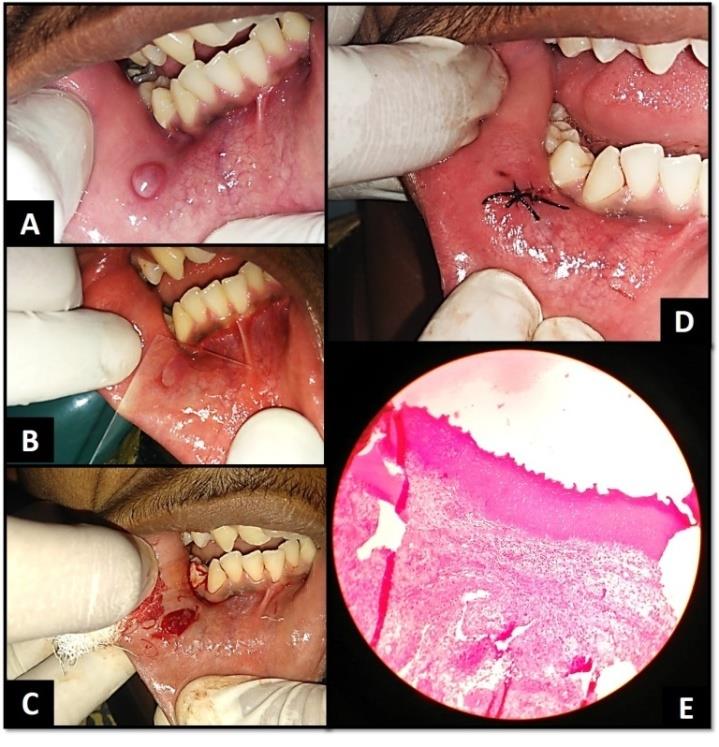 Figure 1: a. Mucocele on the Lower Right Labial Mucosa, b. Diascopy Test Showing No Blanching, c. Labial Mucosa Post Excision, d. Suture Placed Post Complete Excision, e. Histological Photomicrograph Revealing Deeper Tissue Showing an Area of Spilled Mucin Surrounded by Chronic Inflammatory Cells (H & E - 10x).