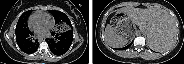 Figure 1: CT shows the right heart, the liver on the left, and the stomach and spleen on the right, which is the whole visceral inversion.