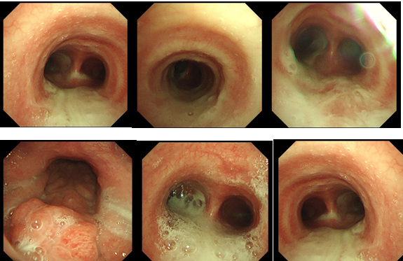 Figure 3: Bronchoscopy: large amount of yellowish-white mucous sputum trapped in the lumen of the trachea, the right and left main bronchi and the bronchial tubes of each lobe segment.