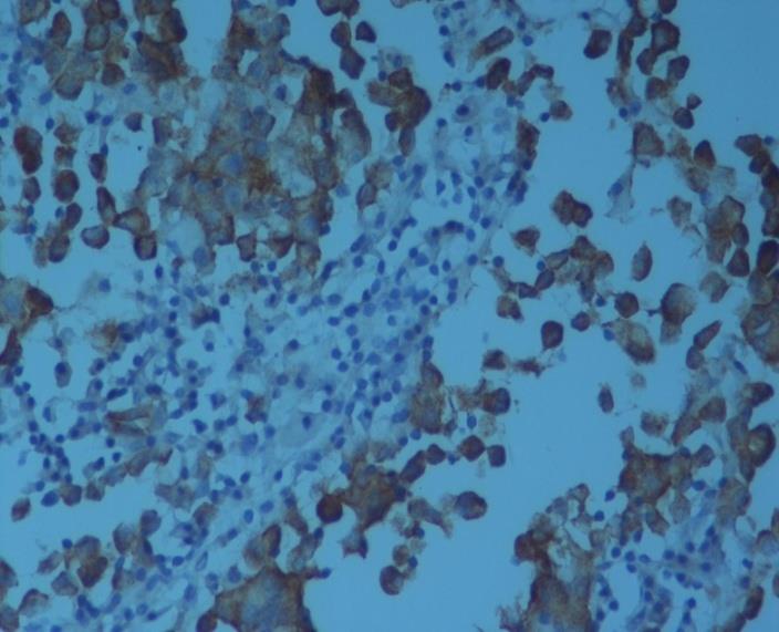 Figure 4: On immunohistochemistry, the tumor cells show positivite NSE.