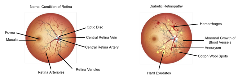 Figure 2: Illustration of the entire retina image. The fundus image on the left depicts the normal retina condition, and the fundus image on the right depicts a retina with diabetic retinopathy symptoms.