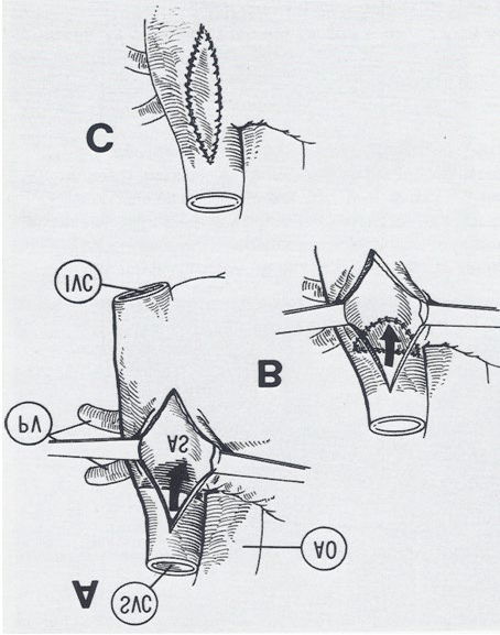 Figure 4: A repeat contrast study following the surgical correction showed opacification of the right heart structures without contrast detected in the left heart after the injection of agitated saline into the arm veins (Figure 5), indicating that the surgery had had good results [5].