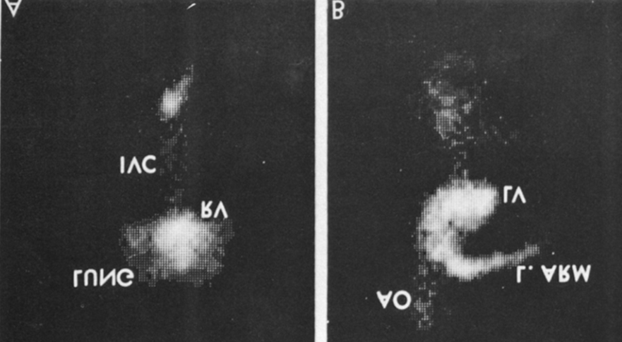 Figure 6: Following surgical correction, recordings similar to those shown in Figures 1 & 2 were made while injecting agitated saline into the veins of the hand, and these reveal contrast in the right ventricular outflow tract (RVOT) (A) and right ventricle (RV) (B), suggesting that the superior vena cava now drains normally into the right atrium (not shown) and RV. AO, aorta; ECG, electrocardiogram; LA, left atrium; LV, left ventricle. Modified from Alpert BS, et al. [5].