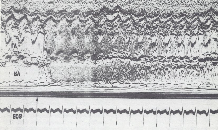 Figure 8: A selected M-mode recording from the parasternal short axis view of the left atrium (LA), aorta (Ao), and right ventricular outflow tract (RVO) was made while injecting agitated saline into the right atrial line, which demonstrates the appearance of contrast echoes almost simultaneously in the Ao and RVO without opacification of the LA, suggesting that there is no inter-atrial shunt and that the shunt is distal to the atria. The time of injection is marked by an arrow at the left top of the Figure 8. ECG, electrocardiogram. Reproduced from Rao PS, et al. [7].