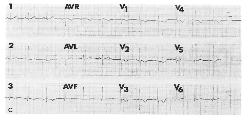 Figure 12: Electrocardiogram at 5.5 years of treatment showing 2: 1 atrioventricular block with a ventricular rate of 66 beats per minute. Reproduced from Rao PS, et al. [20].