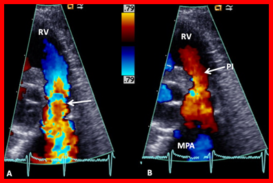 Figure 2: Selected video frames from color flow mapping in a parasternal short axis view demonstrating turbulence originating at the pulmonary valve ring level (arrow in A) and pulmonary insufficiency (PI; arrow) in B. MPA, main pulmonary artery; RV, right ventricle. Reproduced from Alapati S, et al. [10].