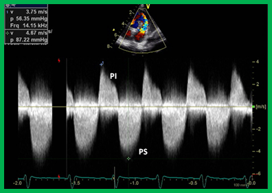 Figure 4: A. Chest x-ray in posterio-anterior view performed prior to surgery demonstrating moderate cardiomegaly with dilated right pulmonary artery (arrows). B. Repeat chest x-ray 12 months following surgery showing near normal sized heart and no prominent pulmonary arteries. Reproduced from Rao PS, et al. [11].