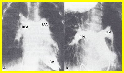 Figure 5: A. Selected cine frame from right ventricular (RV) cine-angiogram demonstrating markedly dilated main, right (RPA) and left (LPA) pulmonary arteries prior to surgery. B. Repeat cine-angiogram performed following surgery demonstrating marked improvement of the branch pulmonary arteries. Modified from Rao PS, et al. [11].