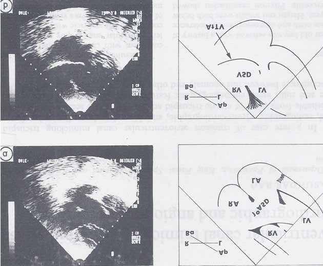Figure 7: Selected two-dimensional, subcostal, four- chamber echocardiographic frames with an open (a) and closed (b) atrioventricular valve. Line drawings on the right of a and b are made for greater clarity and for labeling. A large ostium primum atrial septal defect (10 ASD) is shown in a. When the large atrioventricular valve leaflet is open (a), it completely closes the right ventricle (RV) from the right atrium (RA) and the ventricular septal defect (VSD) and allows the emptying of blood from both atria into the left ventricle (LV). When the atrioventricular valve leaflet is closed (b), it continues to occlude the RV from the RA while allowing the VSD to freely communicate between the RV and LV. Ap, Apex; AtTV, atretic tricuspid valve; Ba, base; L, left; LA, left atrium; R, right. Reproduced from Rao PS [17].