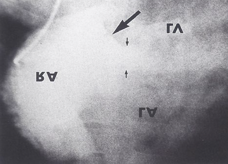 Figure 8: Selected right atrial (RA) angiographic frame in postero-anterior view demonstrating that the floor of the right atrium is formed by one of the leaflets of the atrioventricular valve; this is marked by a large arrow. The contrast material exited the RA via an ostium primum atrial septal defect, shown by small arrows, with subsequent opacification of the left ventricle (LV). LA, left atrium. Reproduced from Rao PS [17].