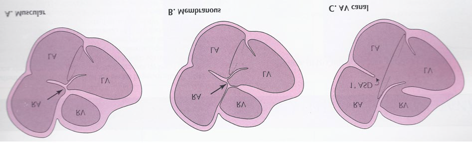 Figure 9: Line drawings demonstrating two-dimensional echocardiographic appearances in a subcostal four- chamber view of the muscular (A), membranous (B), and atrioventricular canal (C) variants of tricuspid atresia. A. The atretic tricuspid valve is represented by a thick band of echoes between the right atrium (RA) and the small right ventricle (RV) in the muscular type. B. The tricuspid valve is represented by a thin line in the membranous type. Note that crux of the heart (arrows in A and B) is clearly seen in both these types (A and B). The attachment of the anterior leaflet of the detectable atrioventricular valve to the left side of the interatrial septum is evident. C. In the atrioventricular canal type of tricuspid atresia, the anterior leaflet of the detectable atrioventricular canal is attached to the anterior wall of the heart, occluding the right ventricle from the right atrium, and allows the exit of blood from both atria into the left ventricle (LV). The crux cordis and the atrioventricular portion of the inter- ventricular septum are not seen. Reproduced from Rao PS [19].