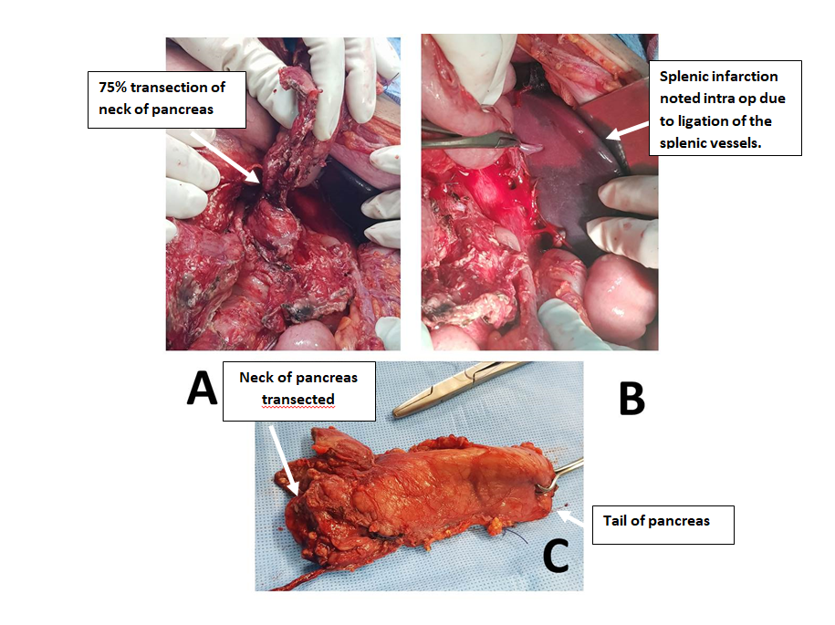 Figure 2: ** intra-operative findings.