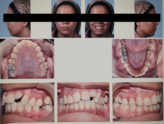 Figure 2: Pre-treatment facial and intraoral photographs.
