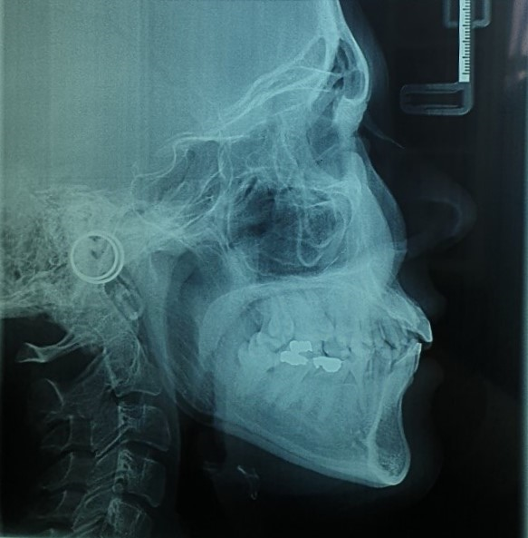 Figure 3: Pre-treatment lateral cephalometry and panoramic view.