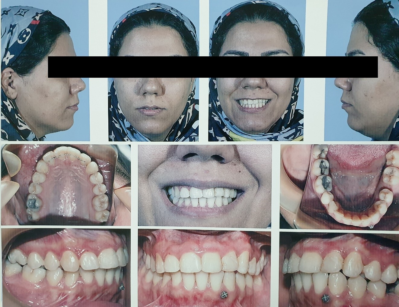 Figure 6: Post-treatment facial and intraoral photographs.