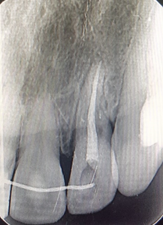 Figure 7: Post-treatment periapical radiograph.