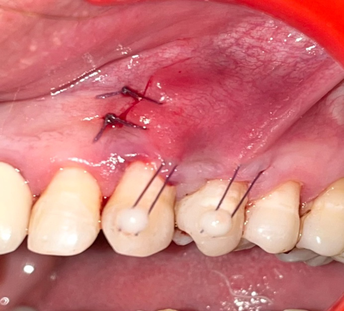 Figure 10: Coronal Advancement of Flap and Suturing.