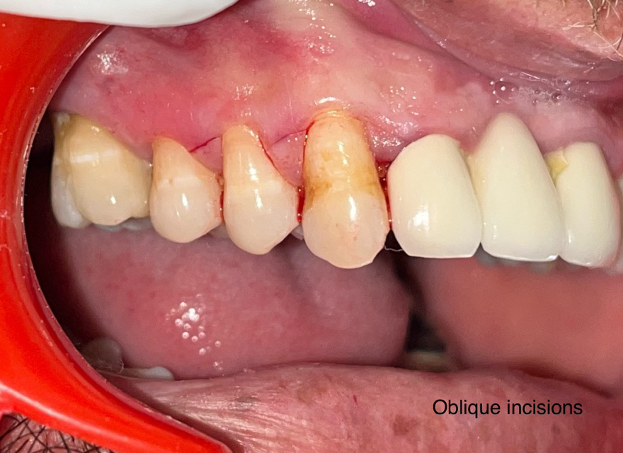 Figure 2: Oblique Incisions.