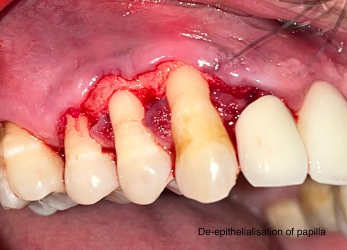 Figure 3: De-Epithelialization of Papilla and Flap Reflection.