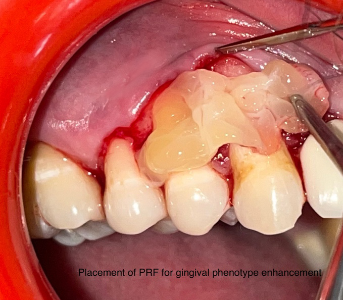 Figure 4: Placement of PRF.