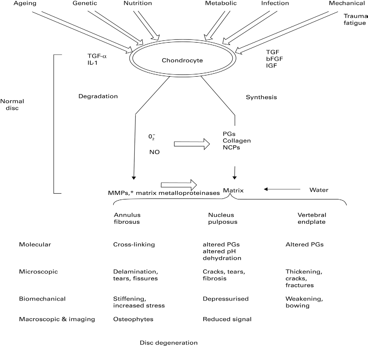Figure 2: A Model Showing Disc Degeneration.