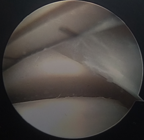 Figure 1: Arthroscopic view of medial ankle plica.