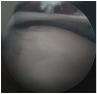 Figure 2: Arthroscopic view of lateral ankle plica.