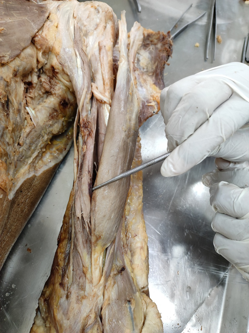 Figure 1: Showing the Photo and illustration of dissection demonstrating the 3rd head along with Long head, Short head, and 4th head of the Biceps Brachii Muscle.