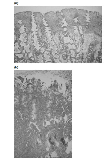 Figure 4: Histological appearance of (a) late secretory and (b) menstrual endometrium (see p. 354). (Courtesy of Professor M Wells, University of Sheffield.) The pituitary secretes the gonadotropin hormones LH and FSH in response to pulses of gonadotropin release (GnRH) from the hypothalamus that travel to the beginning pituitary through the hypothalamo-hypophysial opening lot. LH secretion appears to be carefully contingent on GnRH pulsatility, while the discharge of FSH is co-regulated by hypothalamic GnRH and added determinants that act directly on the pituitary, possibly including inhibins and activins. At the usual follicular point, GnRH rhythm repetitiveness is approximately per 90-second brief period. GnRH pulses were less frequent in the luteal chapter, occurring approximately every 4 h. Disorders that slow GnRH pulsatility, in the same way, that eating disorders influence the loss of secretion of pituitary gonadotropins and a state of hypogonadal hypogonadism accompanying imperceptible antitoxin LH and FSH and amenorrhea, Once the aggregation of serum estradiol starts to rise in the intervening follicular step, hasty suppression of pituitary FSH results in a negative response. Recent studies have suggested that suppression of pituitary FSH discharge in the follicular phase may be co-intervened by increasing antitoxin concentrations of inhibin B, a glycoprotein hidden by the granulosa containers of the cultivating organism’s smallest living organism. It is not surprising that a two-fold device to control follicular- time FSH discharge has evolved [4]. The decrease in the flowing aggregation of FSH withdraws gonadotropin ‘drive’ from the balance of the increasing cohort of follicles. The result is progression to atresia for almost the smallest living organism, leading to mono-ovulation.