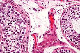 Figure 1: Germ cell neoplasia in situ demonstrating enlarged, atypical cells imbued with abundant cytoplasm, enlarged, hyperchromatic nuclei with coarse nuclear chromatin and prominent nucleoli. Neoplastic cells layer the basement membrane of seminiferous tubules.
