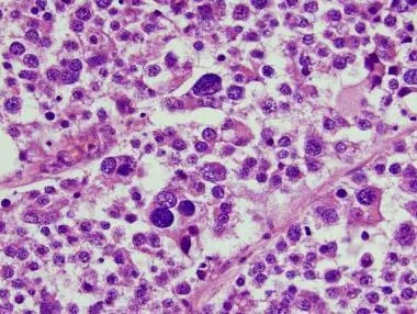 Figure 1: Spermatocytic tumour composed of tripartite cells as small, intermediate and giant cells traversed by fibrous tissue septa [7].