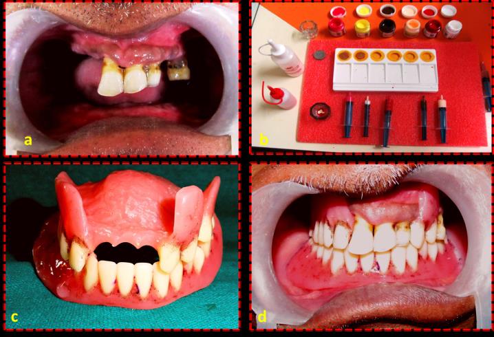 Figure 1: a. Intra oral view of natural teeth showing cervical stains; b. Fabrication of tabs with various shades; c. Stained prosthesis; d. Intra oral view of completed prosthesis with characterization.
