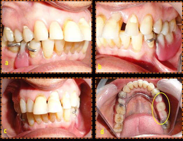 Figure 1: a,b: Cast partial denture with proper occlusion; c. increased overjet; d. reduced cuspal anatomy The patient was educated about the problem by making diagnostic casts with a partial denture present, which were then mounted on a semi adjustable articulator that was programmed according to patient condylar guidance.