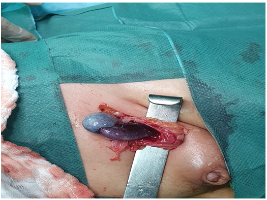 Figure 1: An orchiectomy is then performed. Anatomopathological study revealed ischemic necrosis of testicular parenchyma with no sign of malignancy.