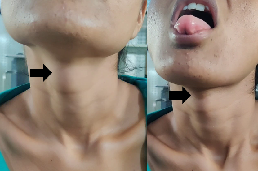 Figure 1: ** Clinical picture of midline neck swelling which moves with protrusion of tongue.