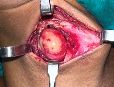 Figure 3: Intraoperative picture of the thyroglossal duct cyst.