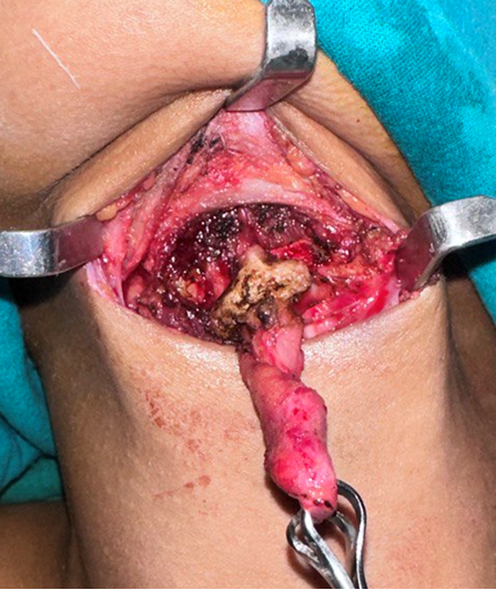 Figure 4: Intraoperative picture showing thyroglossal tract cyst in relation with body of hyoid.