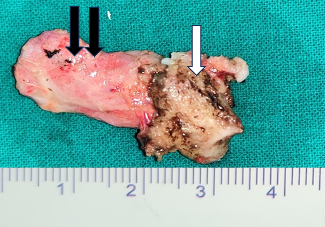 Figure 5: Surgical specimen of thyroglossal duct cyst. (Single white arrow- body of hyoid, double black arrow- thyroglossal cyst).