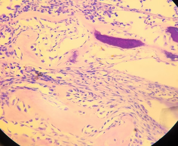 Figure 5: Photomicrograph Showing Serous Papillary Tumor with Osseous Metaplasia (H&E Stain,200x).