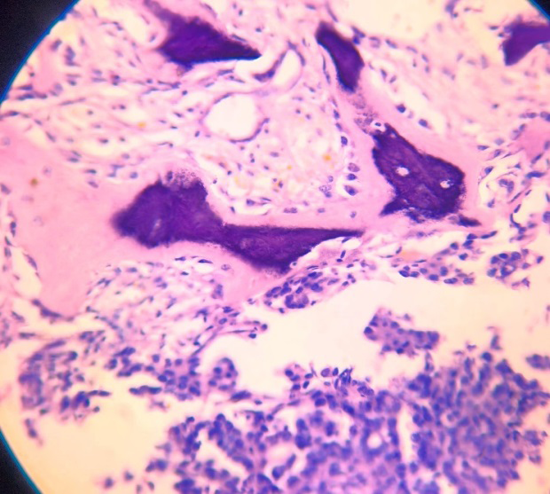 Figure 6: Photomicrograph of the Right Ovarian Low Grade Serous Cystadenocarcinoma with Calcification and the Lamellar Bone of Osseous Metaplasia (H&E Stain,400x).