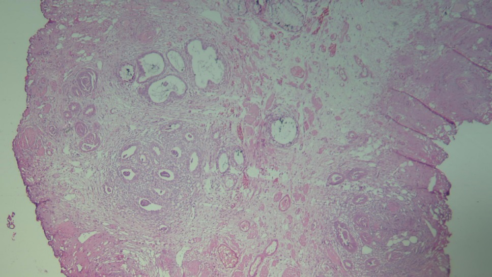 Figure 1: Low Power View of Endometriotic Foci in Bladder Wall Tissue.