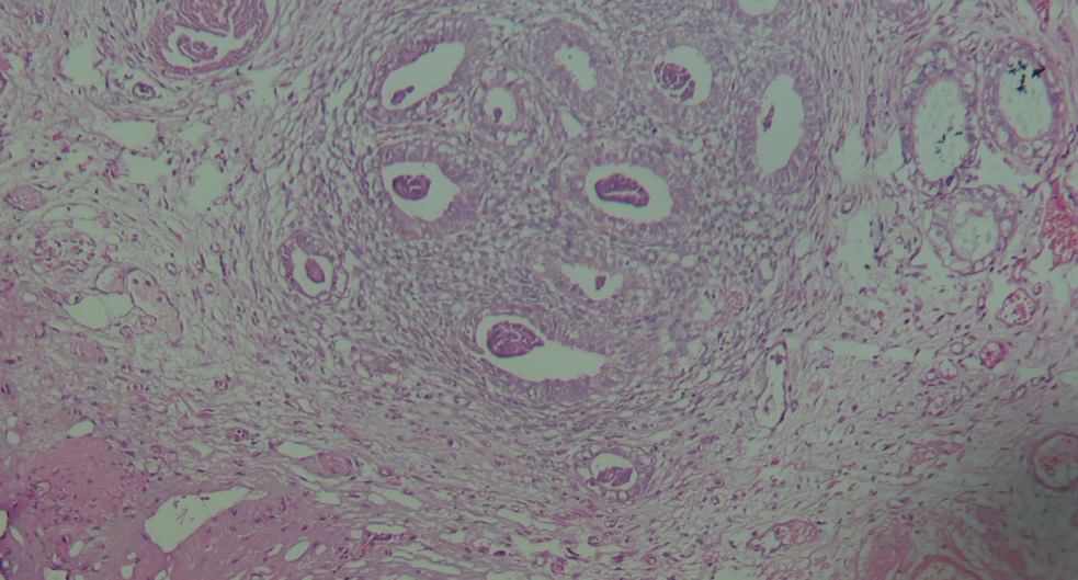 Figure 2: High Power View of Bladder Endometriosis.
