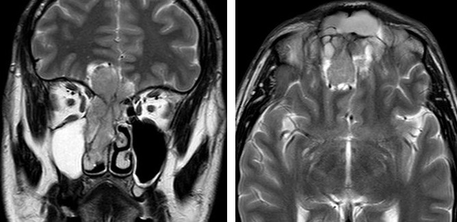 Figure 1: ** Esthesioneuroblastoma Kadish C - A, B: Coronal and Axial MRI Showing the Tumor with Endocranial Extension; C: Endonasal View of the Tumor Surgery; D: Endonasal Resection; E: The Orbit Fat is Observed After Resecting the Periorbita (Black Arrow); F: External Bifrontal Craniotomy (Black Arrow); G: Reconstruction of the Defect with a Pericranial Flap; H: Postoperative CT (Anterior Skull Base Reconstruction with a Pericranial Flap is Observed (Yellow Arrow).